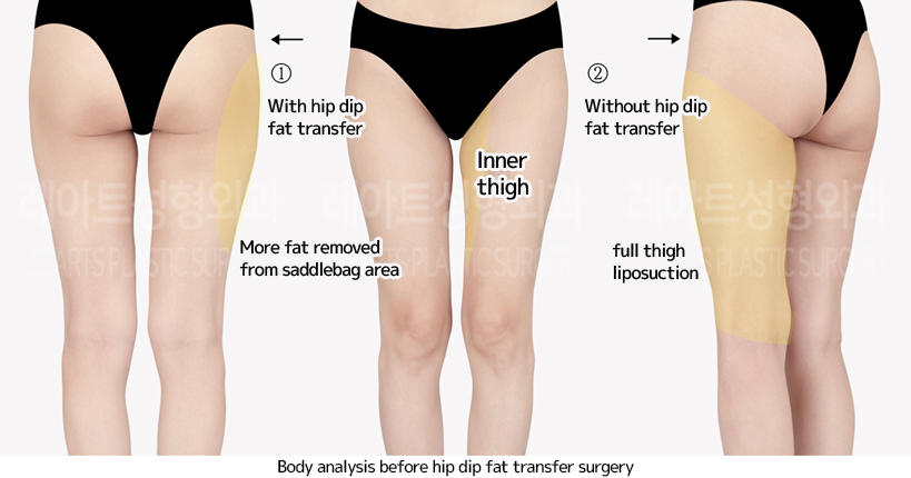 thigh_liposuction_02_01_240703