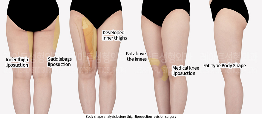 thigh_liposuction_02_01_240715