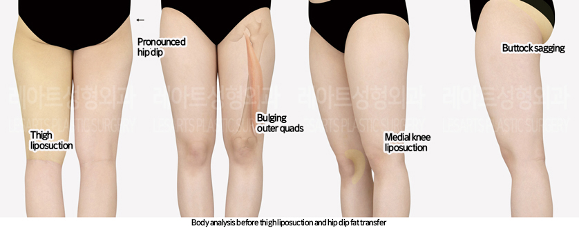 thigh_liposuction_02_01_240805