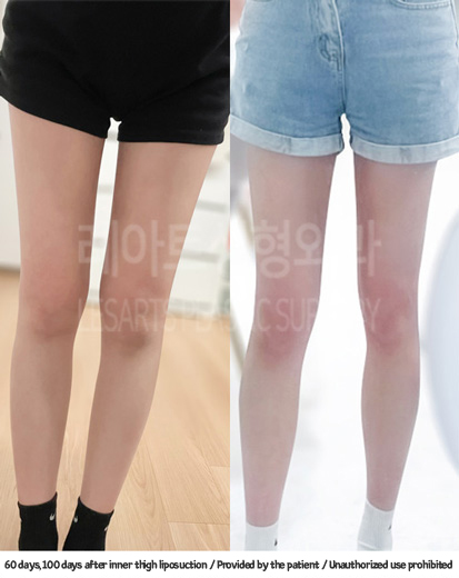thigh_liposuction_02_02_231229