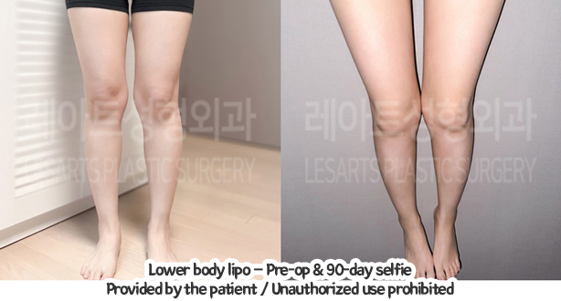 thigh_liposuction_02_02_240109