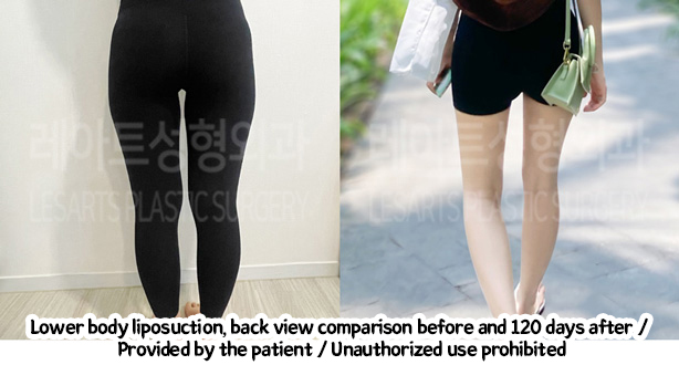 thigh_liposuction_02_02_240220