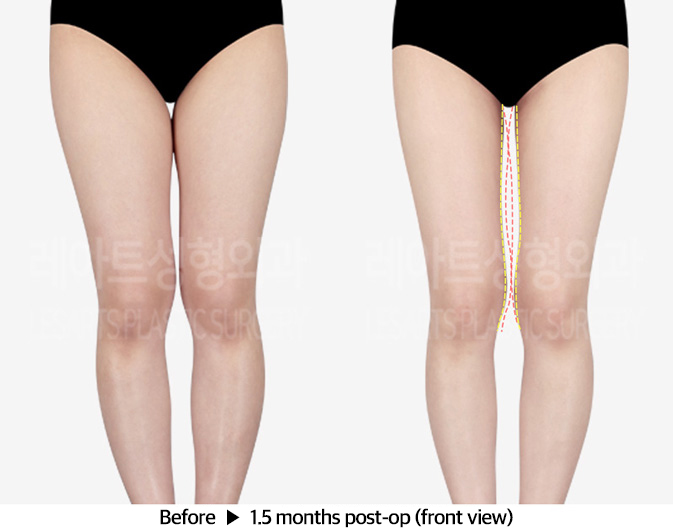 thigh_liposuction_02_02_240312