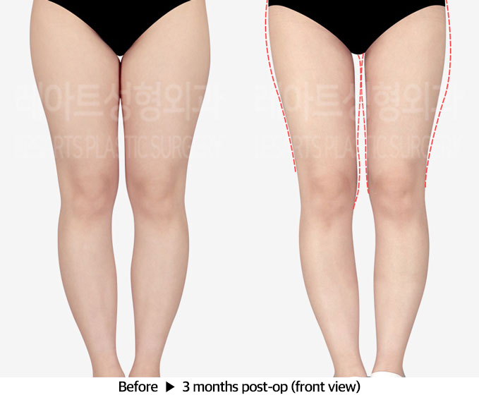 thigh_liposuction_02_02_240318