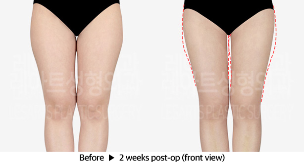 thigh_liposuction_02_02_240321