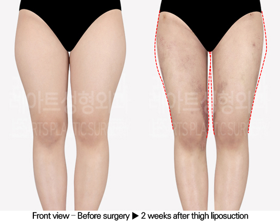 thigh_liposuction_02_02_240513