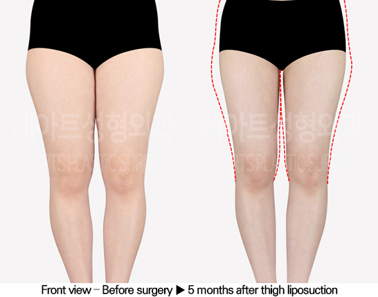 thigh_liposuction_02_02_240517