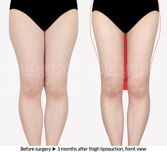 thigh_liposuction_02_02_240603