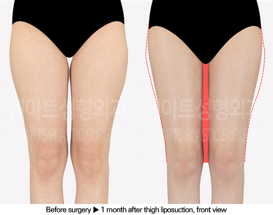 thigh_liposuction_02_02_240613