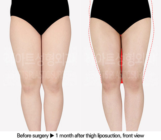 thigh_liposuction_02_02_240618