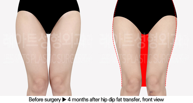 thigh_liposuction_02_02_240628