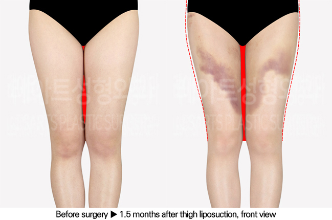 thigh_liposuction_02_02_240701