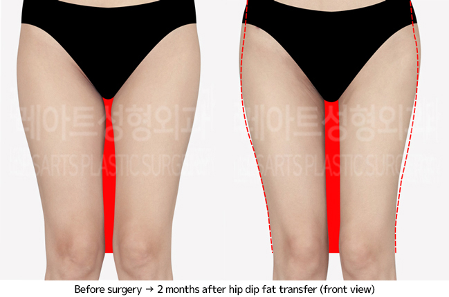 thigh_liposuction_02_02_240703