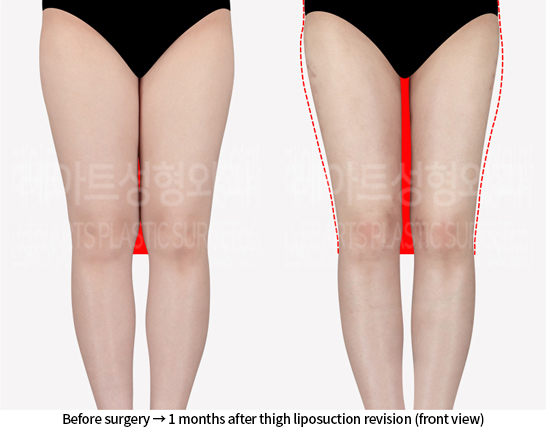 thigh_liposuction_02_02_240715