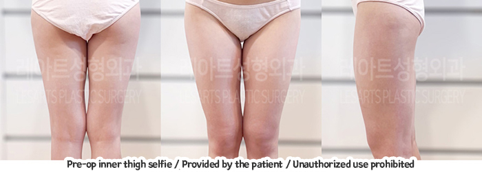 thigh_liposuction_02_03_231229