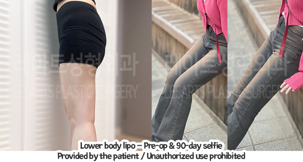thigh_liposuction_02_03_240109