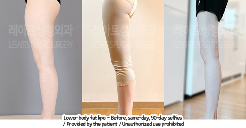 thigh_liposuction_02_03_240124