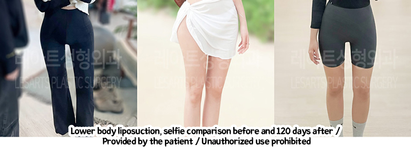 thigh_liposuction_02_03_240220