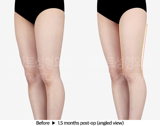 thigh_liposuction_02_03_240312