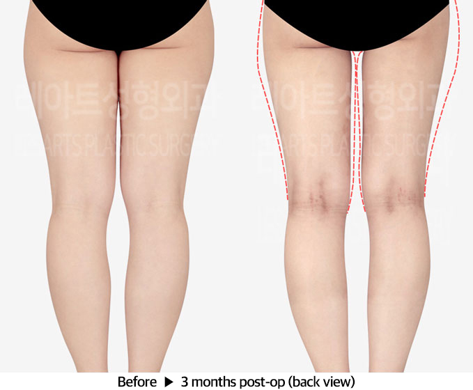 thigh_liposuction_02_03_240318