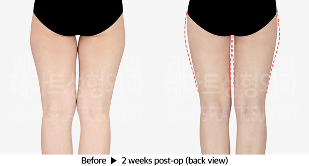 thigh_liposuction_02_03_240321