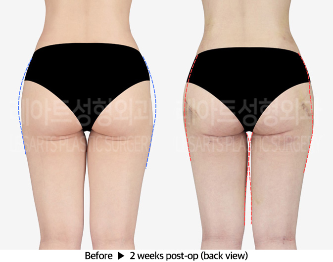 thigh_liposuction_02_03_240401