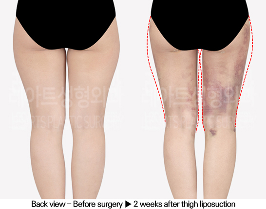 thigh_liposuction_02_03_240513