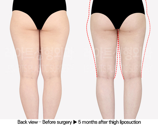thigh_liposuction_02_03_240517