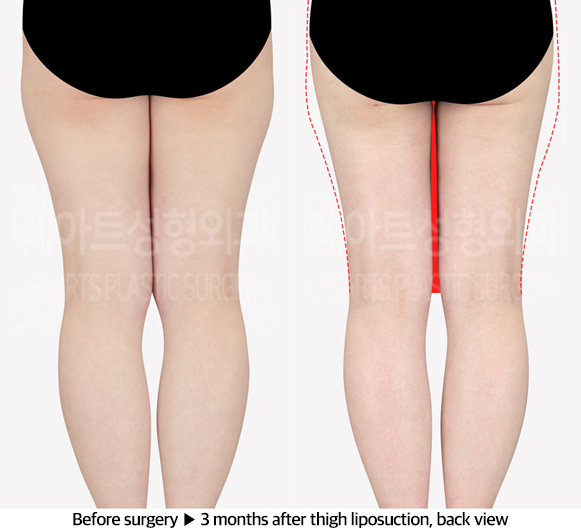 thigh_liposuction_02_03_240603