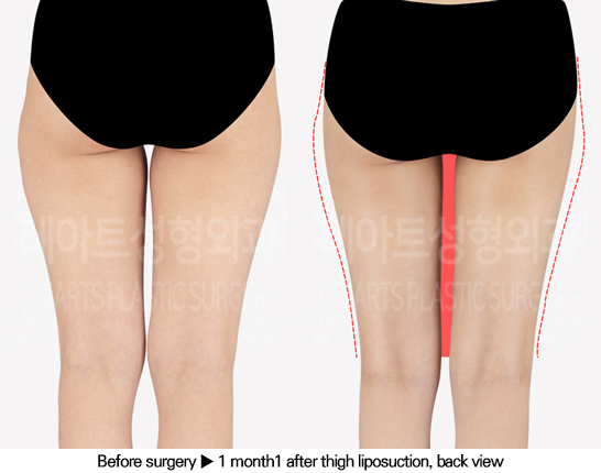 thigh_liposuction_02_03_240613
