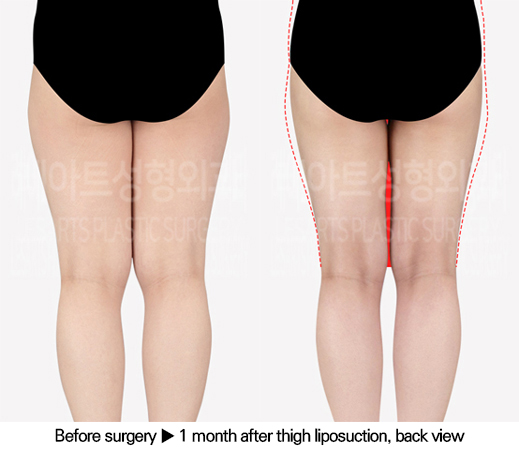 thigh_liposuction_02_03_240618