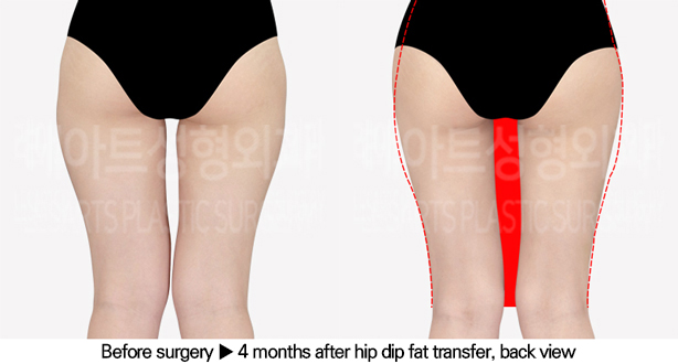 thigh_liposuction_02_03_240628