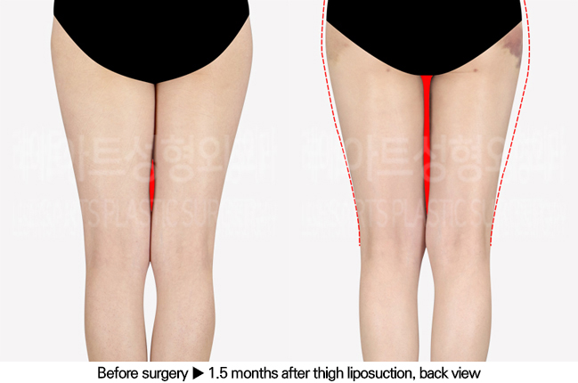 thigh_liposuction_02_03_240701