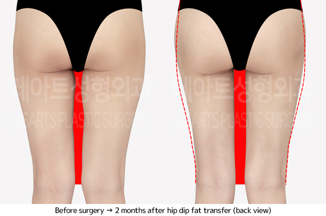 thigh_liposuction_02_03_240703