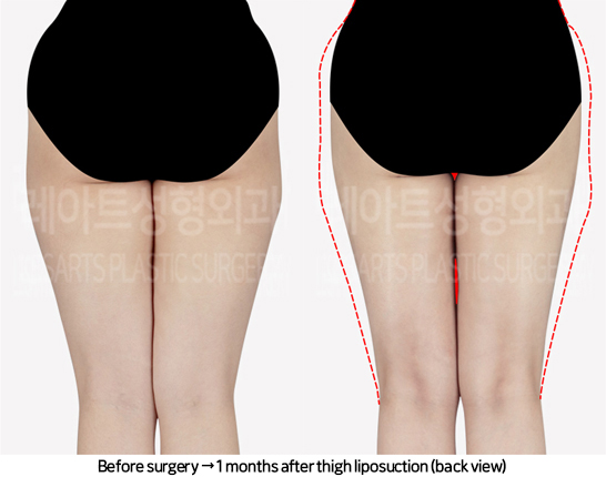 thigh_liposuction_02_03_240711
