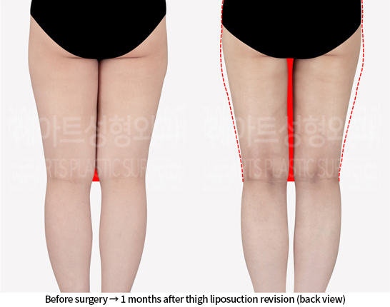 thigh_liposuction_02_03_240715
