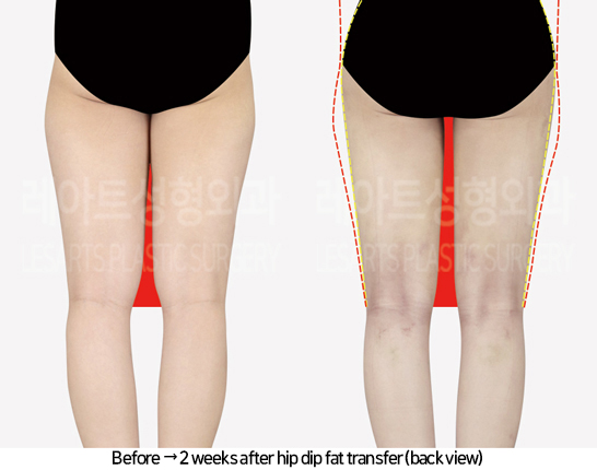 thigh_liposuction_02_03_240805