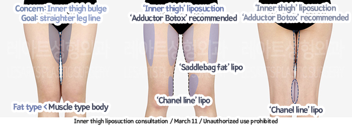thigh_liposuction_02_04_231229
