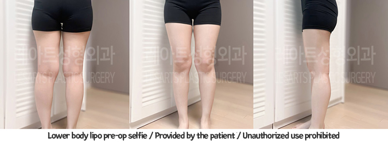 thigh_liposuction_02_04_240109