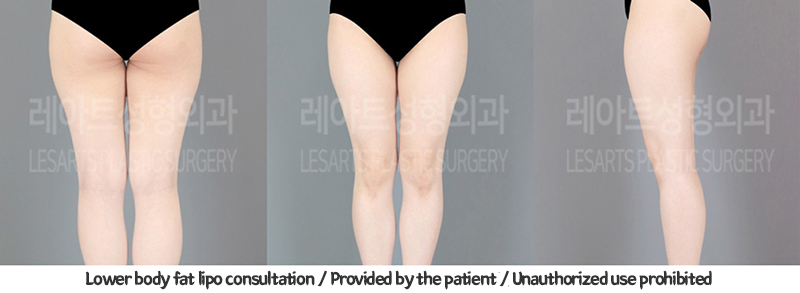 thigh_liposuction_02_04_240124