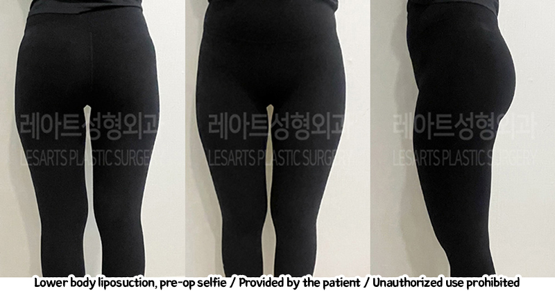 thigh_liposuction_02_04_240220