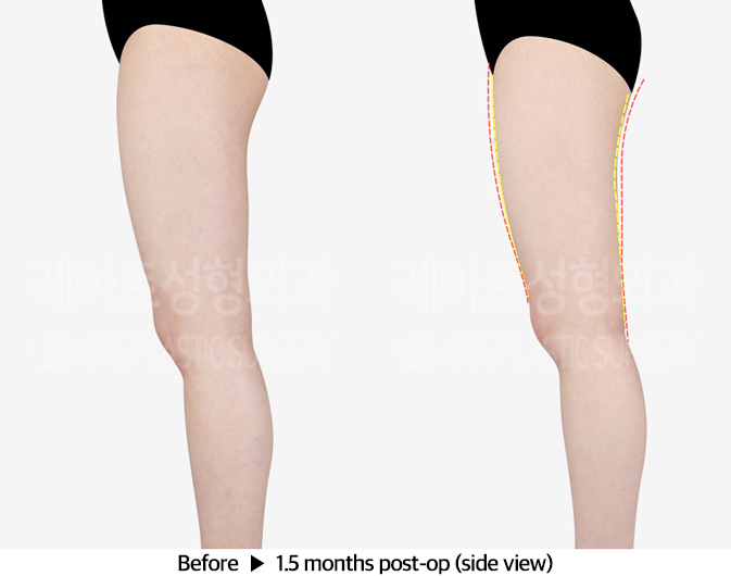 thigh_liposuction_02_04_240312