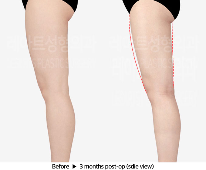thigh_liposuction_02_04_240318