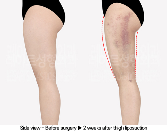 thigh_liposuction_02_04_240513