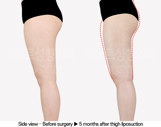thigh_liposuction_02_04_240517