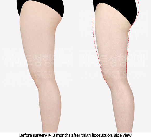 thigh_liposuction_02_04_240603