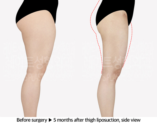thigh_liposuction_02_04_240607