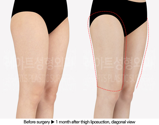 thigh_liposuction_02_04_240613