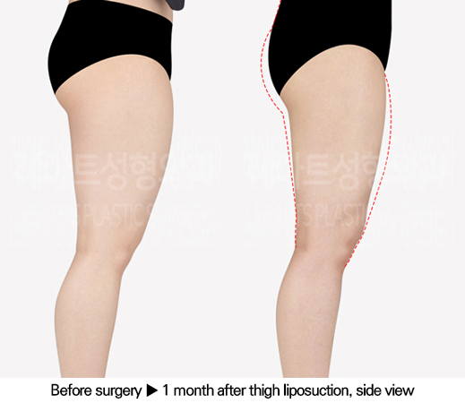 thigh_liposuction_02_04_240618