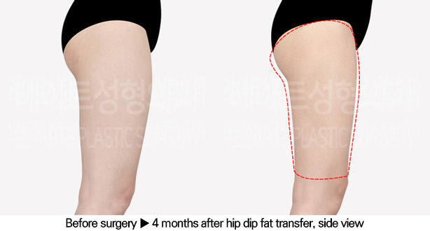 thigh_liposuction_02_04_240628